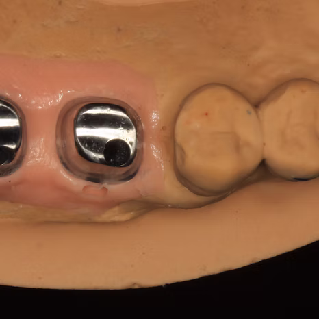 임플란트 보철 · Custom abutment