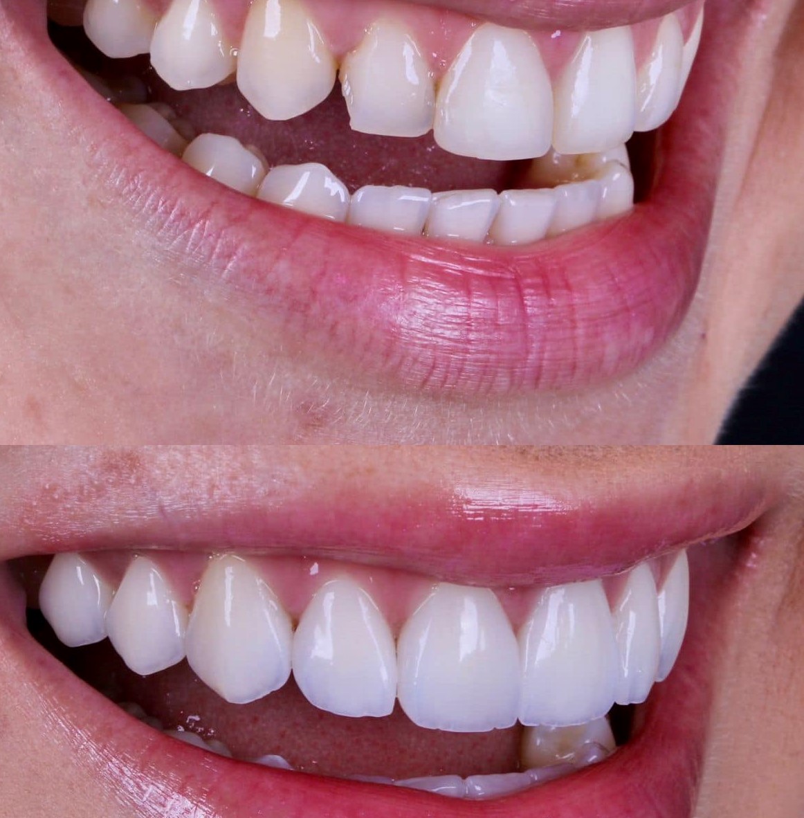 디지털 고정성 보철 · Zirconia